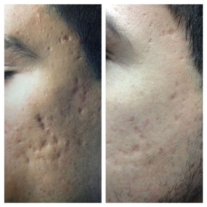 Before-After one acne scar treatment