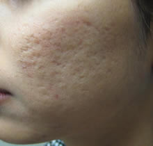 CO2 fractional Acne before