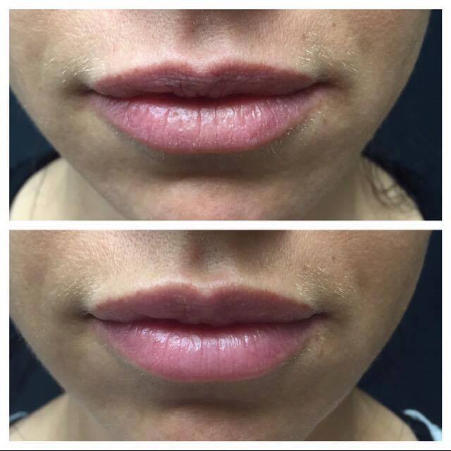 Lip Enhancements Victoria Park Medispa Winnipeg Manitoba Canada