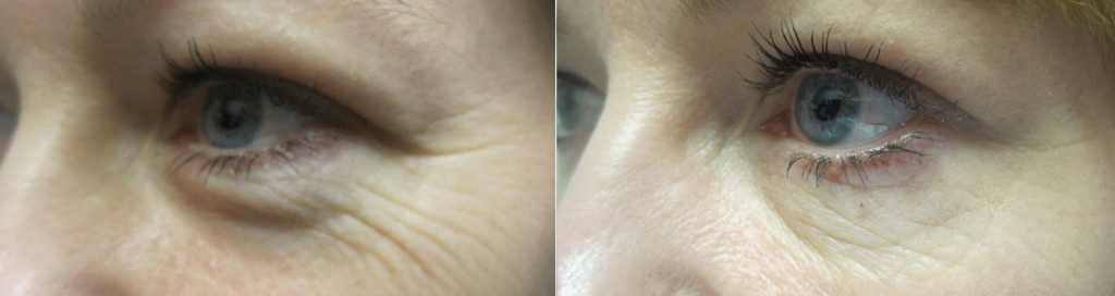 Botox for Crow's Feet in Winnipeg at Dr. Minuk's SkinClinic & Laser Centre