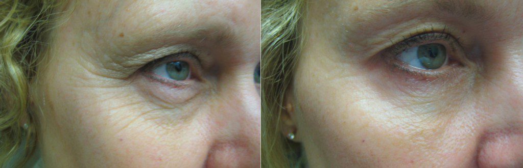 Botox for Crow's Feet in Winnipeg at Dr. Minuk's SkinClinic & Laser Centre