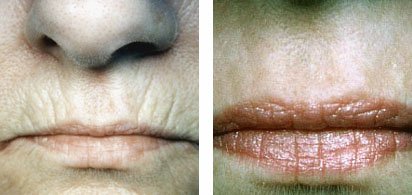 Lip lines vanish with CO2 laser