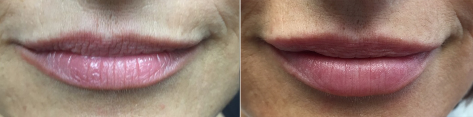 Lip Enhancements by Dr. Minuk