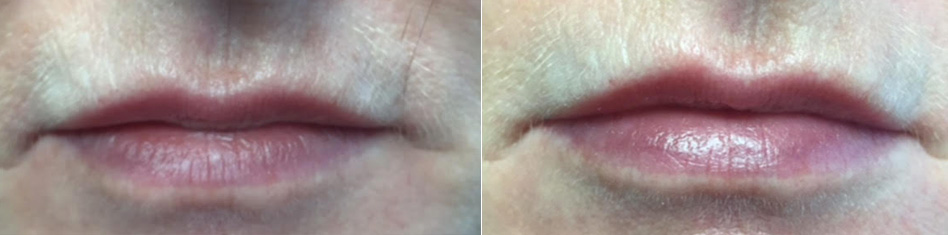Lip Enhancements by Dr. Minuk in Winnipeg
