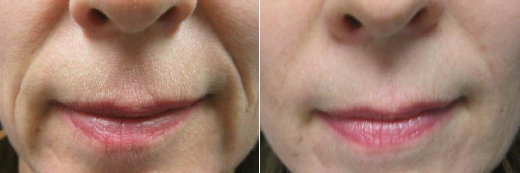 Smile lines (Juvederm Voluma) at Dr. Minuk's SkinClinic and Laser Centre